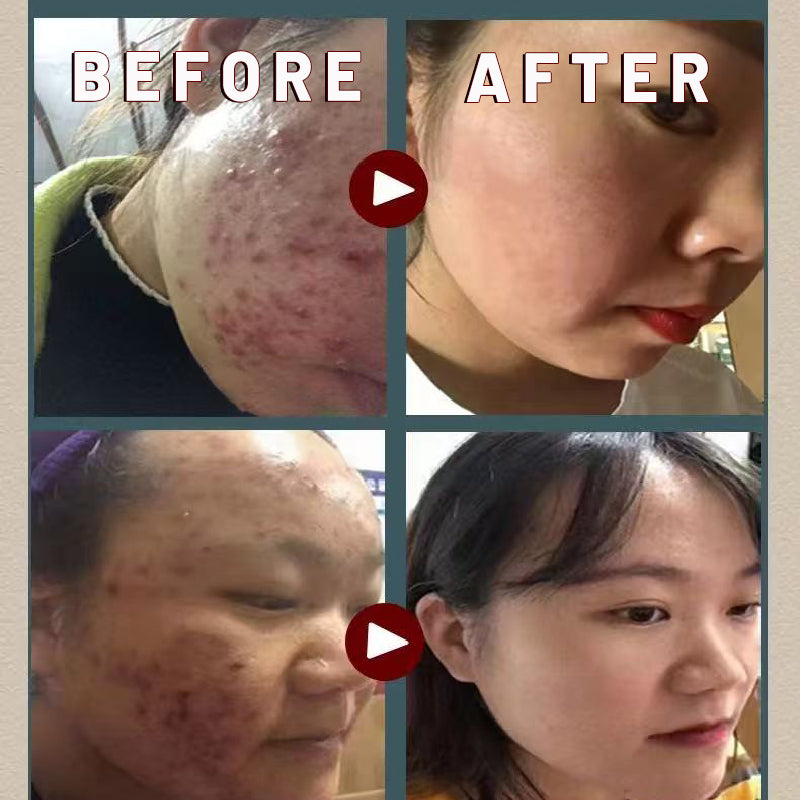 Herbal Powder for Acne