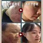 Herbal Powder for Acne